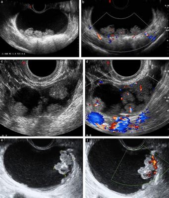 what is mural nodule in ovarian cyst? how does it affect the prognosis of ovarian cancer?